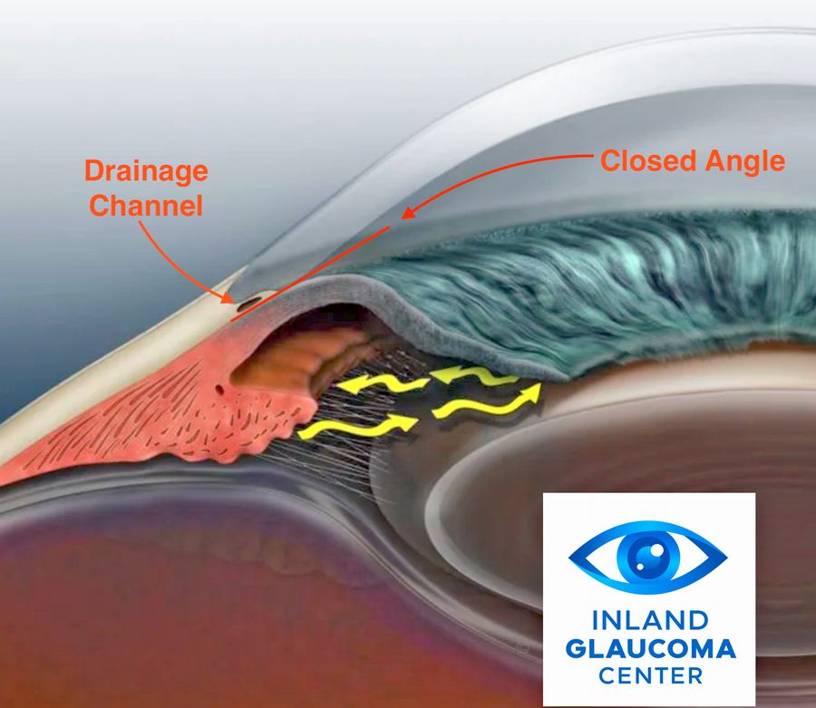 Closed drainage angle in angle-closure glaucoma