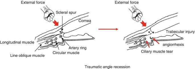Angle recession caused by eye trauma