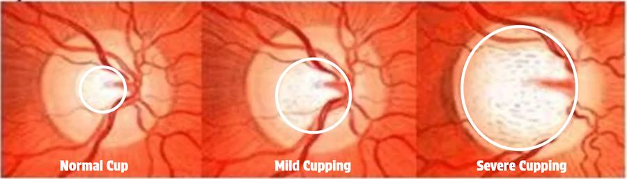 Normal, mild, and severe optic nerve cupping compared