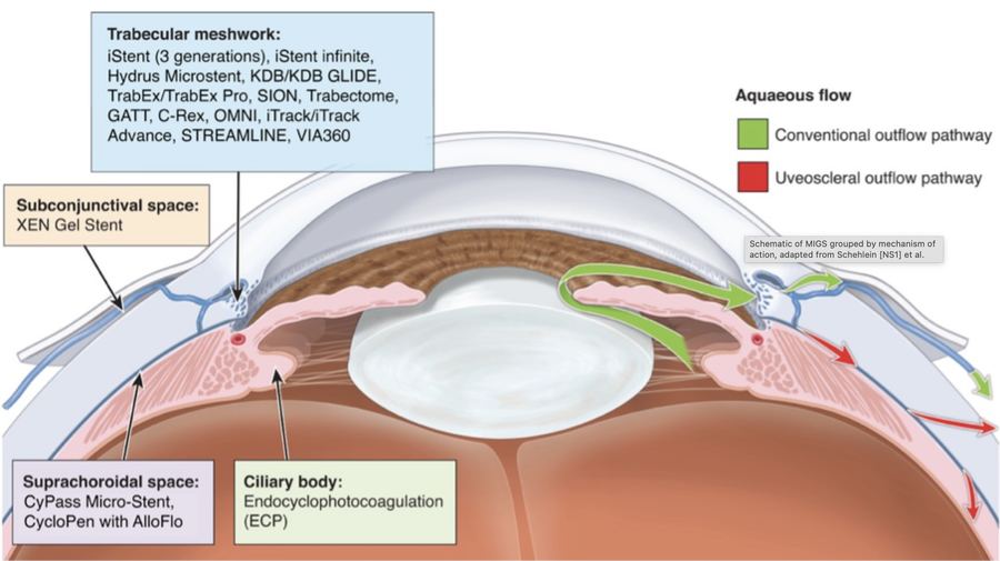 Placement of MIGS devices during glaucoma surgery