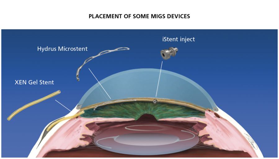 MIGS device options for glaucoma: Hydrus, Xen gel stent, and iStent inject