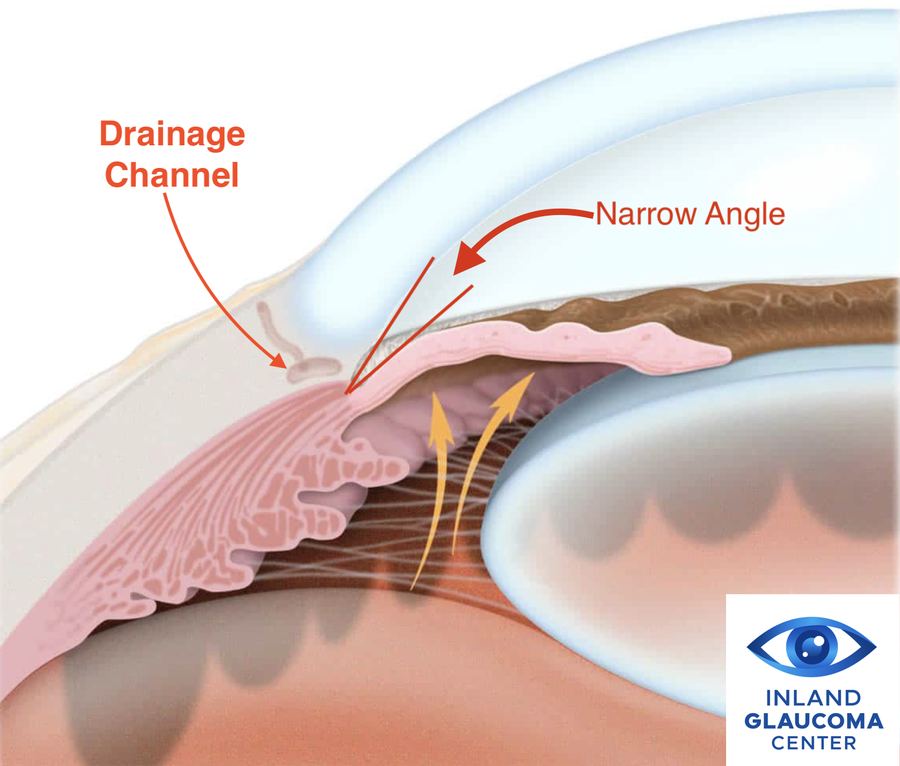 Narrow drainage angle in narrow-angle glaucoma