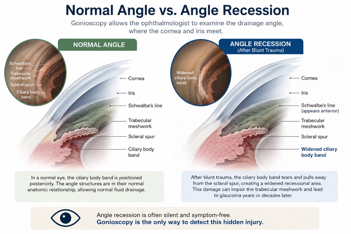 Gonioscopy comparison showing a normal drainage angle beside angle recession with a widened ciliary body band after blunt trauma