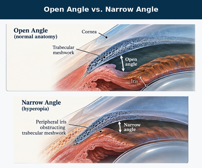 Cross-section diagram of an open drainage angle in normal anatomy compared with a narrow angle in hyperopia, where the peripheral iris obstructs the trabecular meshwork
