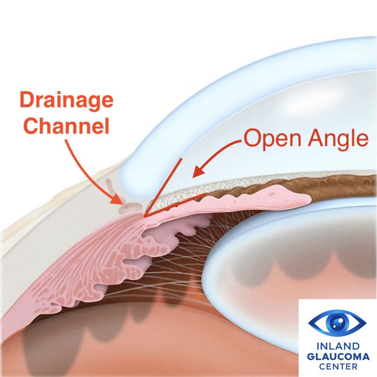 Open drainage angle in open-angle glaucoma