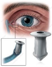 Punctal plugs used to manage dry eye