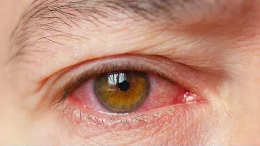 Eye redness and irritation from long-term glaucoma eye-drop use