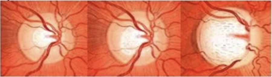 Progression of optic nerve cupping in glaucoma