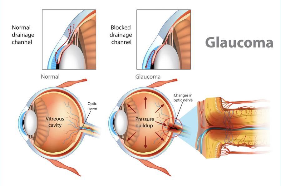How a blocked drainage angle raises eye pressure in glaucoma