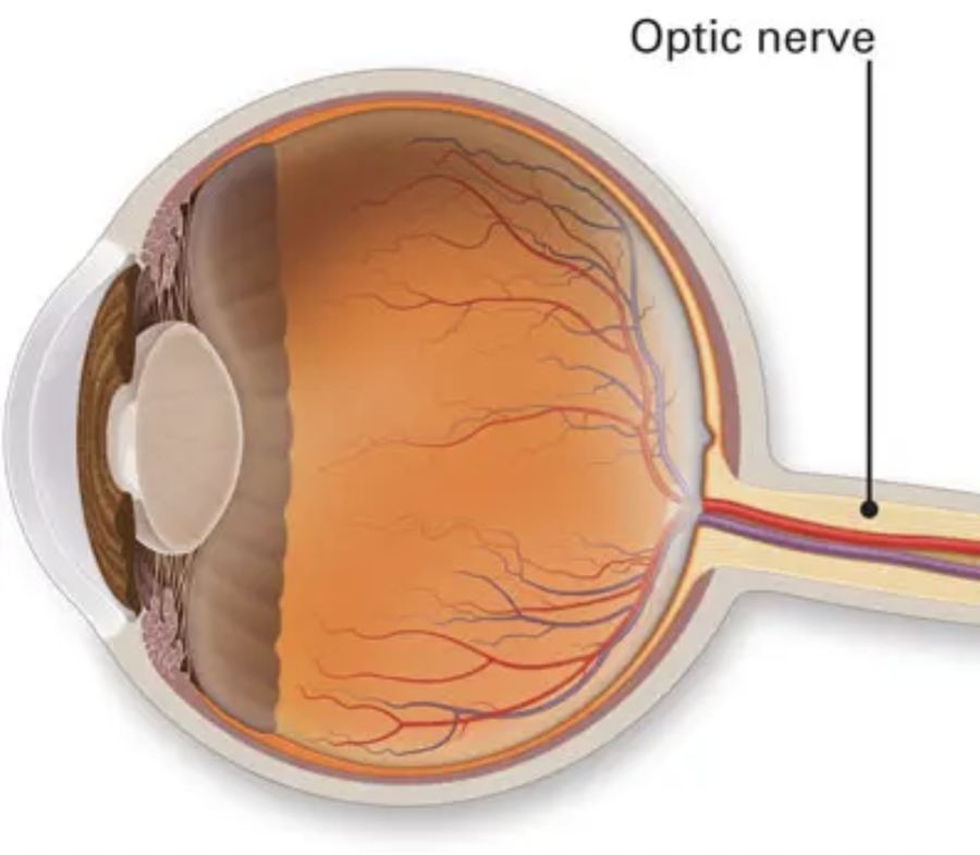 Optic nerve anatomy affected by glaucoma