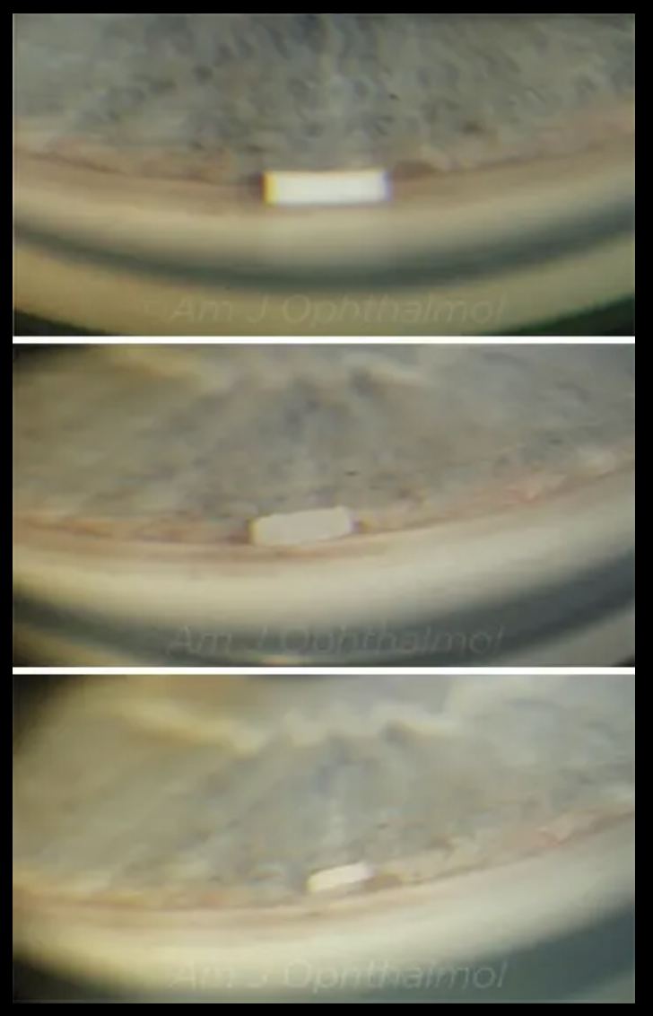 Views of the eye's drainage angle during examination