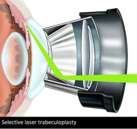 Selective laser trabeculoplasty (SLT) as a drop-sparing glaucoma treatment