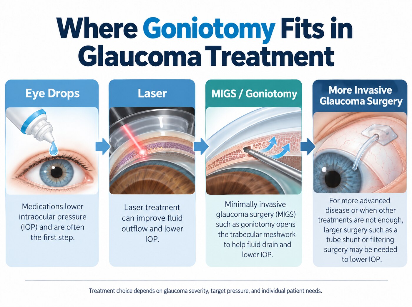 Where goniotomy fits in glaucoma treatment: eye drops, laser, MIGS such as goniotomy, and more invasive glaucoma surgery such as a tube shunt or filtering surgery